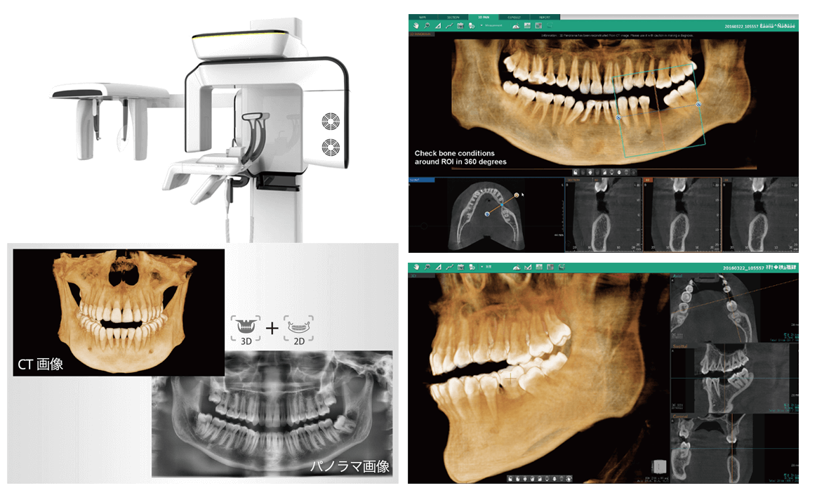 歯科用3DCT
