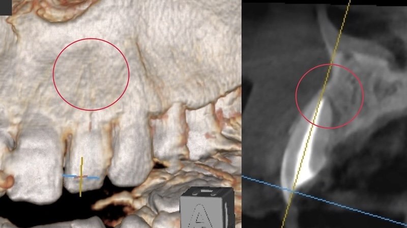 赤羽の歯医者での歯科用CT半年後｜骨再生が確認できた精密根管治療の成功例
