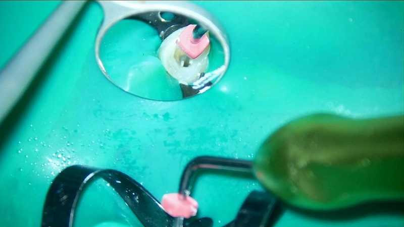 赤羽の歯医者で使用するMTAセメント｜精密根管治療で再感染を防ぐ高封鎖材料