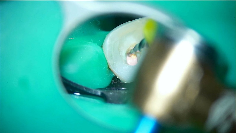 赤羽の歯医者での再根管治療｜感染したガッタパーチャ除去と内部洗浄｜痛くない治療