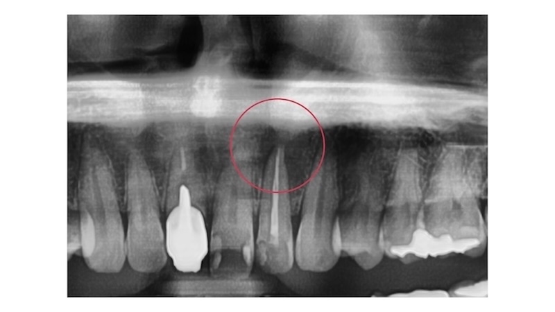 赤羽の歯医者でのパノラマレントゲン画像｜抜歯診断された歯の全体評価と根管治療の判断