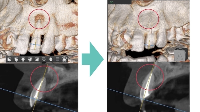 赤羽の歯医者でのCT比較画像｜精密根管治療前後で骨欠損が改善した症例
