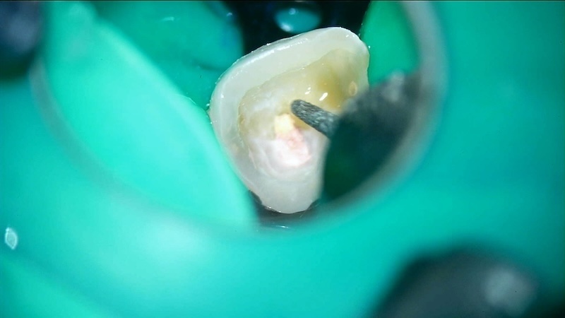 赤羽の歯医者で行うラバーダム防湿｜痛くない精密根管治療で細菌感染を防ぐ処置
