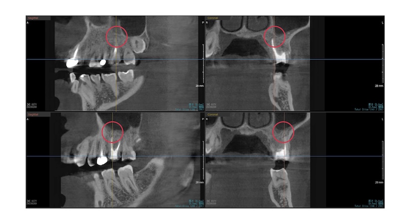 赤羽の歯医者での歯科用CT半年後|骨再生が確認できた精密根管治療の成功例