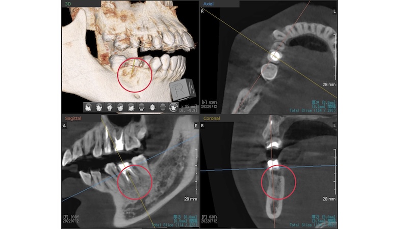 赤羽の歯医者での歯科用CT1年後|骨再生が確認できた精密根管治療の成功例