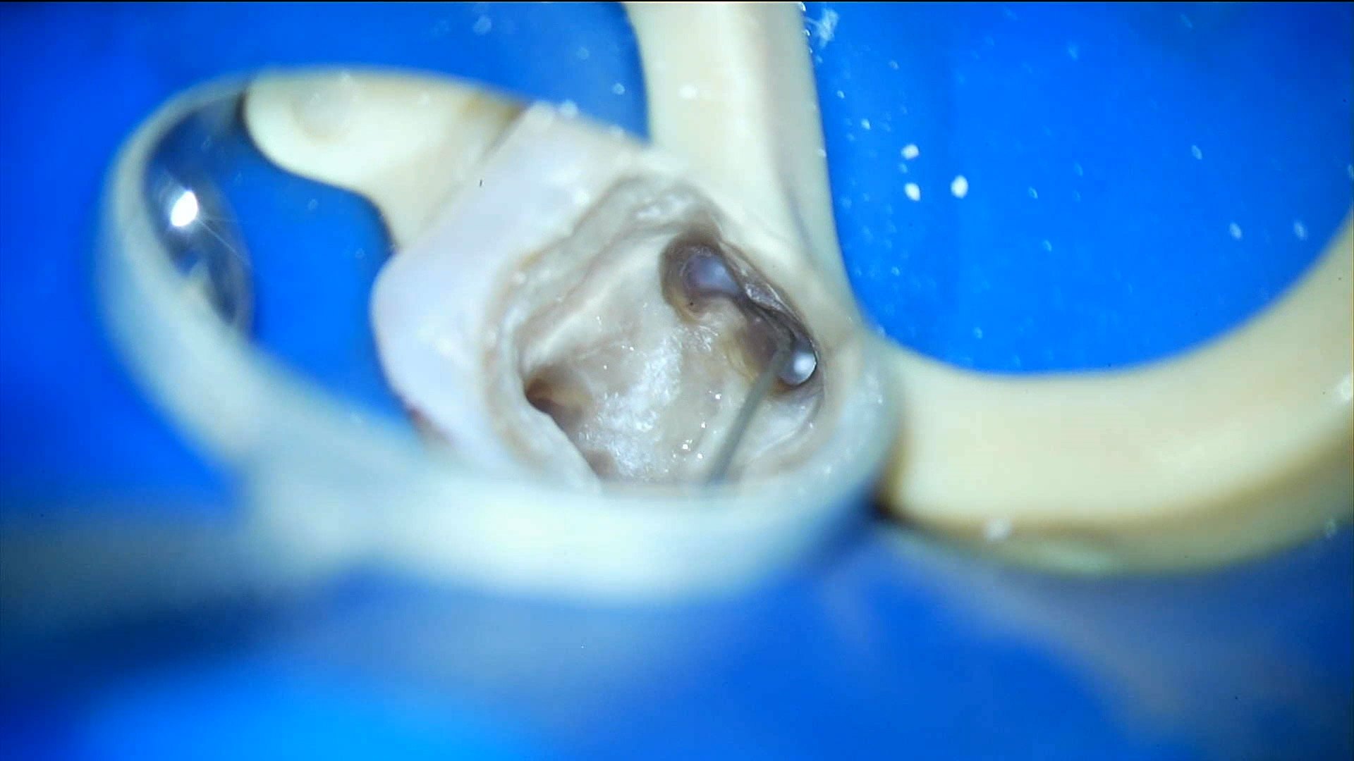 赤羽の歯医者での再根管治療｜感染したガッタパーチャ除去と内部洗浄｜痛くない治療
