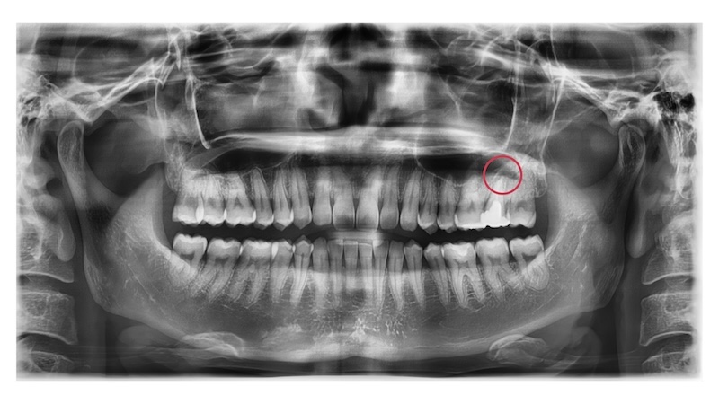 赤羽の歯医者でのパノラマレントゲン画像｜抜歯かもと診断された歯の全体評価と根管治療の判断