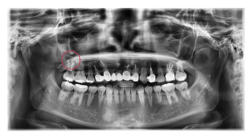 赤羽の歯医者でのパノラマレントゲン画像|激通歯の全体評価と根管治療の判断