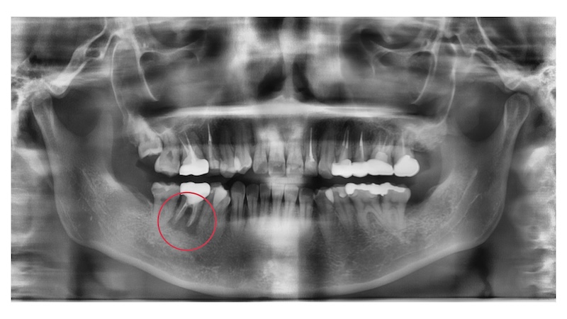 赤羽の歯医者でのパノラマレントゲン画像|異常無しと診断された歯の全体評価と根管治療の判断