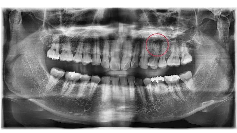 赤羽の歯医者でのパノラマレントゲン画像｜定期検診　歯の全体評価と根管治療の判断