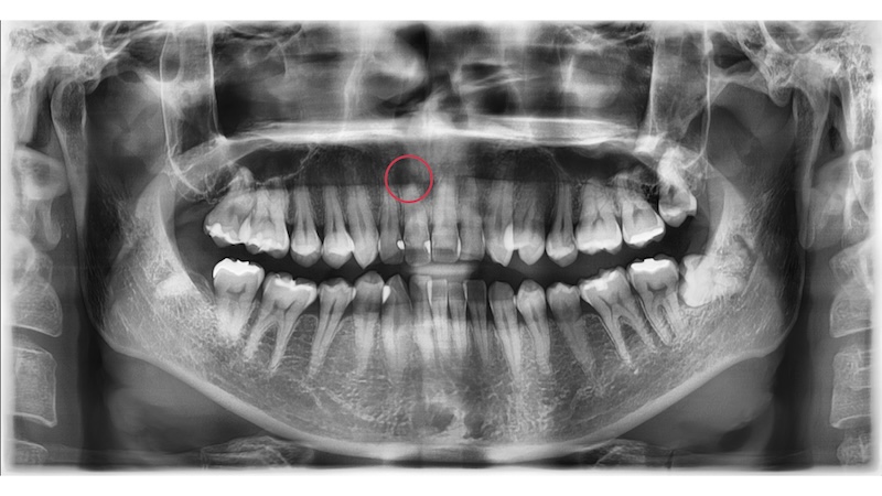 赤羽の歯医者でのパノラマレントゲン画像|変色歯の全体評価と根管治療の判断