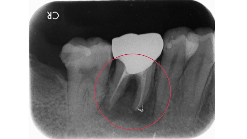 赤羽の歯医者でのレントゲン画像|異常なしと診断された歯の全体評価と根管治療の判断