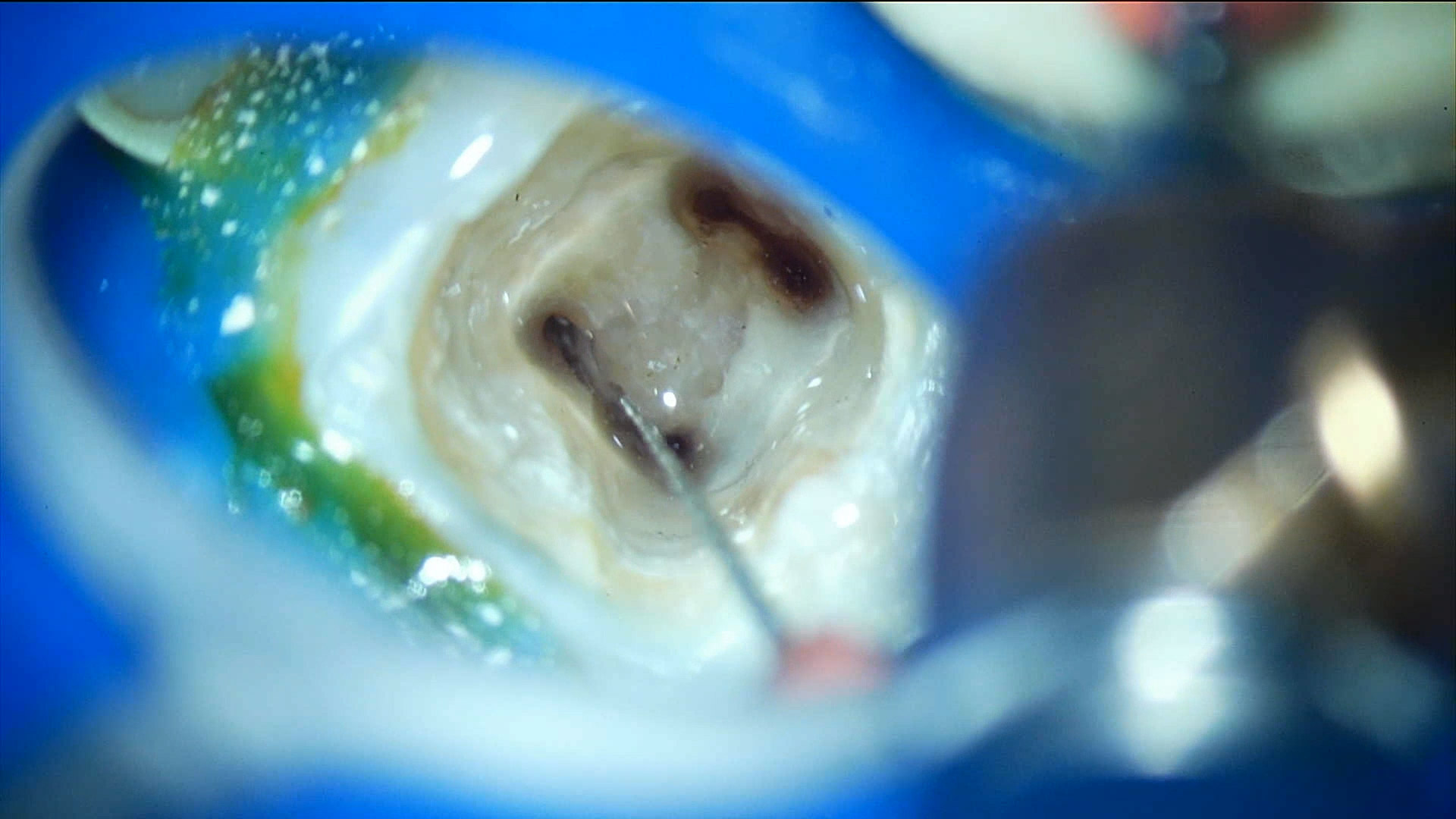 赤羽の歯医者での再根管治療｜感染したガッタパーチャ除去と内部洗浄２｜痛くない治療
