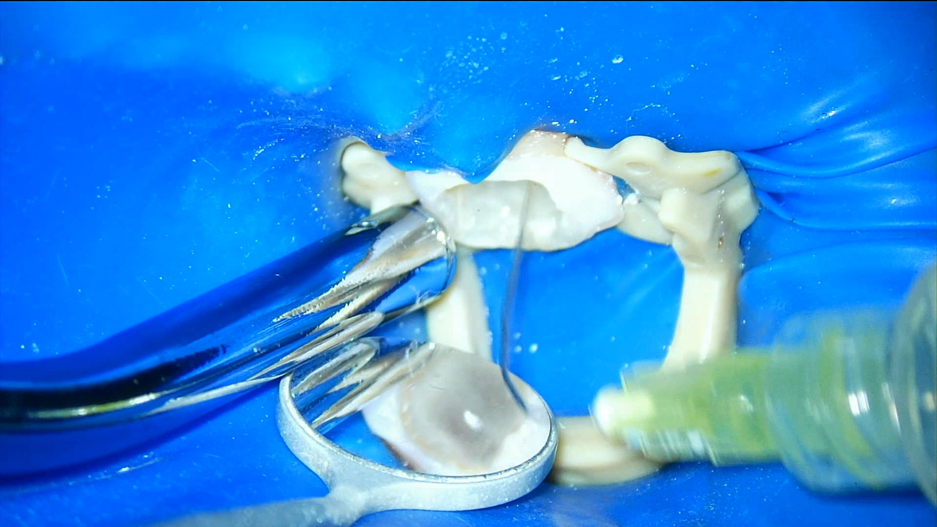 赤羽の歯医者で行うラバーダム防湿｜痛くない精密根管治療で細菌感染を防ぐ処置
