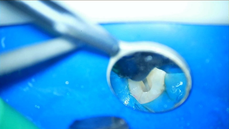赤羽の歯医者で行うラバーダム防湿｜痛くない精密根管治療で細菌感染を防ぐ処置
