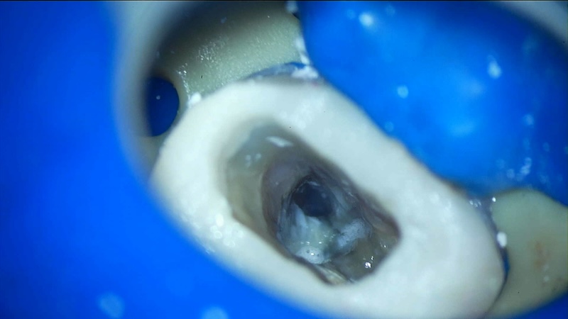 赤羽の歯医者で行うラバーダム防湿｜痛くない精密根管治療で細菌感染を防ぐ処置